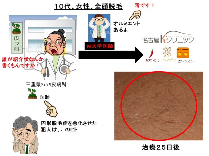 円形脱毛症　病院